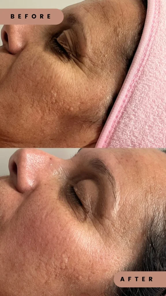 Facial anti age Edmonton