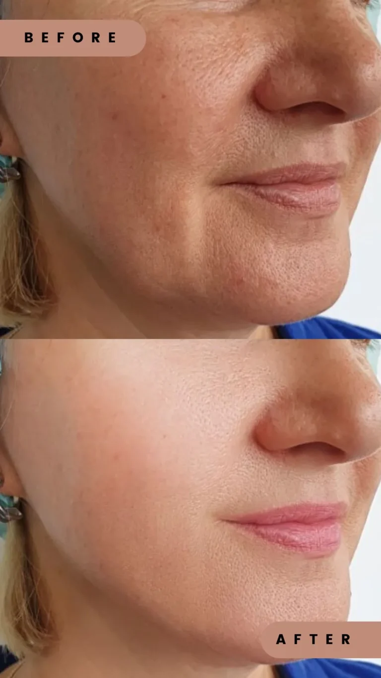 Before and after photo of a woman’s face showing visible improvement in skin tone, texture, and brightness after a professional brightening facial in Edmonton