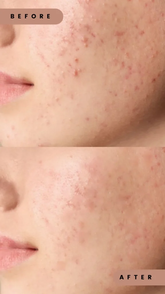 Blackhead Removal in Edmonton