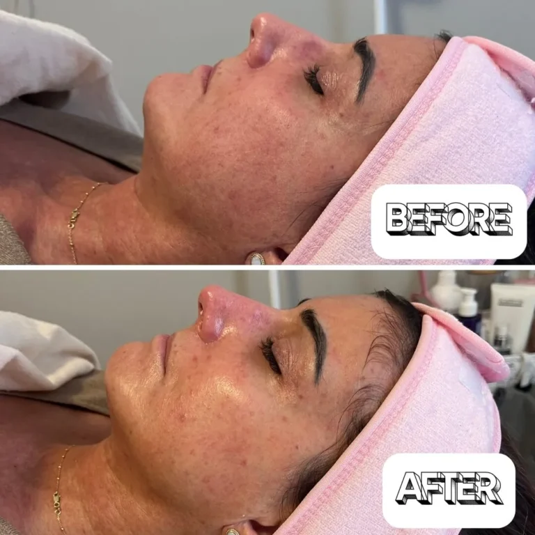 Rosacea treatment before and after